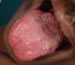 Dorsum of tongue showing presence of atrophic candidiasis.