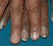 Zidovudine-induced nail hyperpigmentation, compared to normal fingernails.