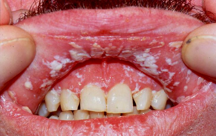 Sintomas cetosis boca dulce