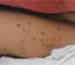 Skin lesions caused by Cryptococcus neoformans.