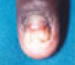 Onychomycosis; fungal infection of the fingernail.