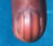 Onychomycosis; fungal infection of the fingernail.
