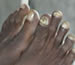 Onychomycosis; fungal infection of the toenails. 
