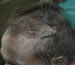 Diffuse alopecia with seborrhoeic dermatitis.