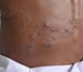 Herpes zoster: vesicular lesions on the trunk.